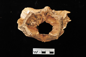 cervical vertebra